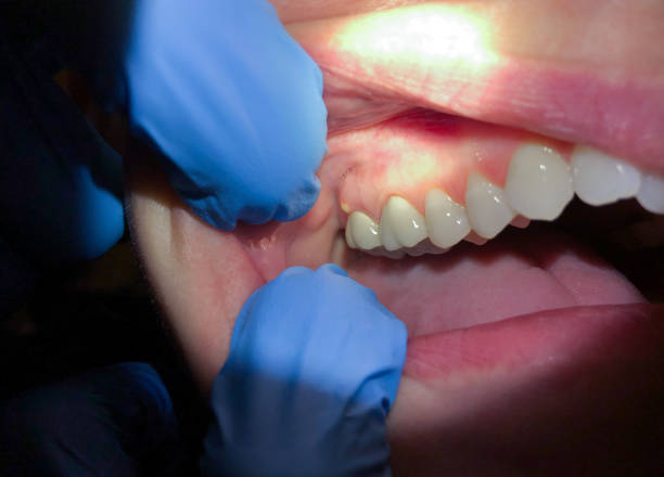 Best Emergency Dental Care for Broken or Chipped Teeth in Three Lakes, FL